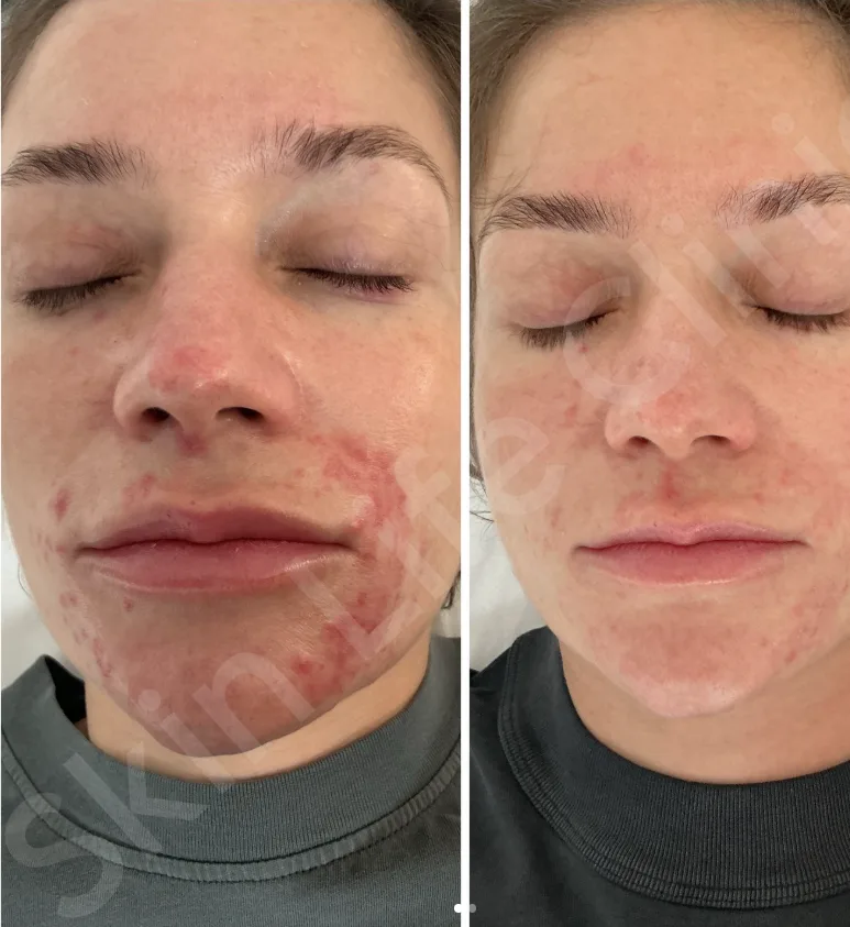 Dermalux LED therapy, before and after