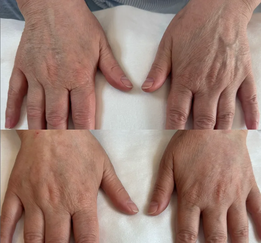 Hand rejuvenation with hyaluronic acid, before and after