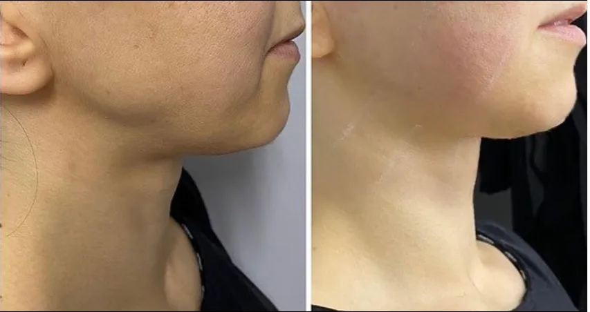 HIFU lifting, before and after