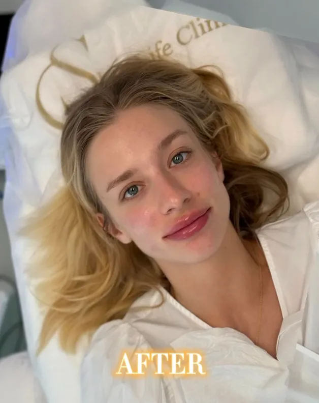 Lip augmentation, after