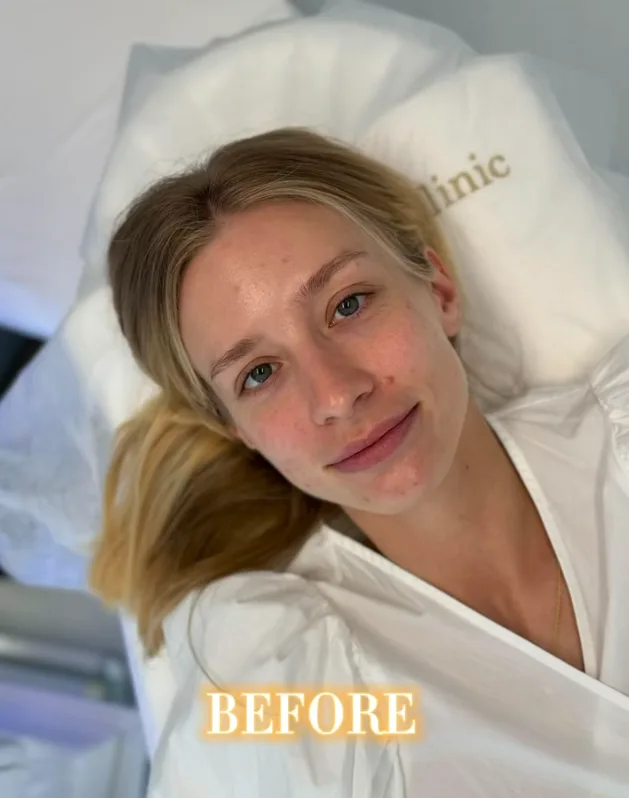Lip augmentation, before