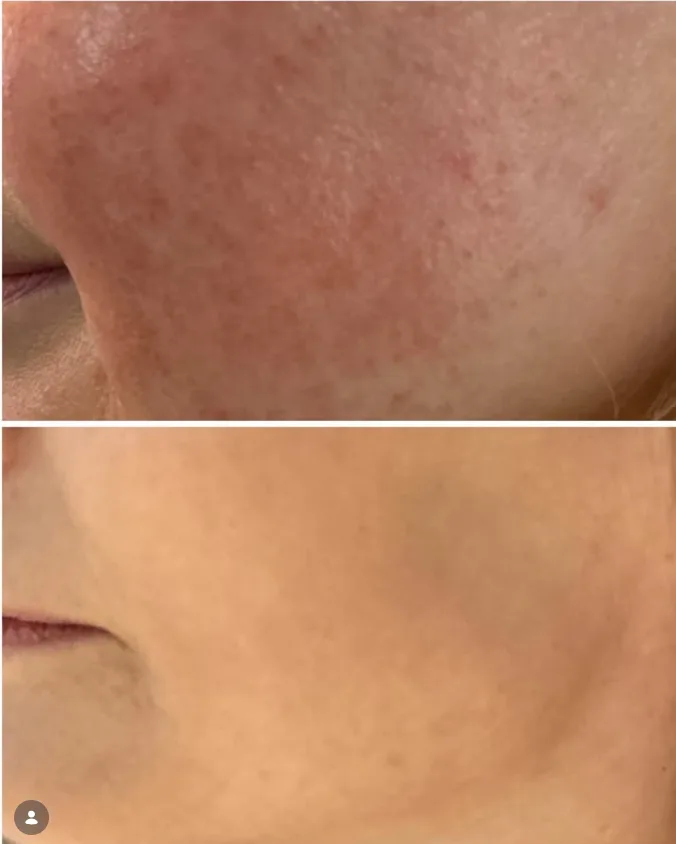 Lumecca Peak, before and after