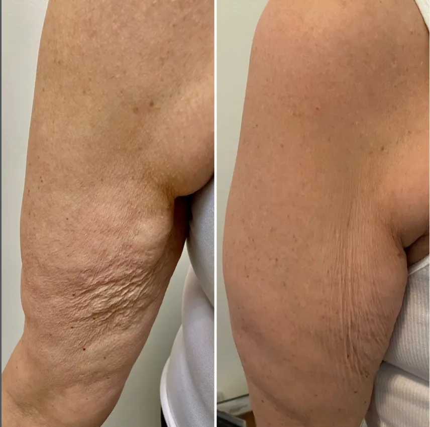 Morpheus8 OptimasMAX, before and after